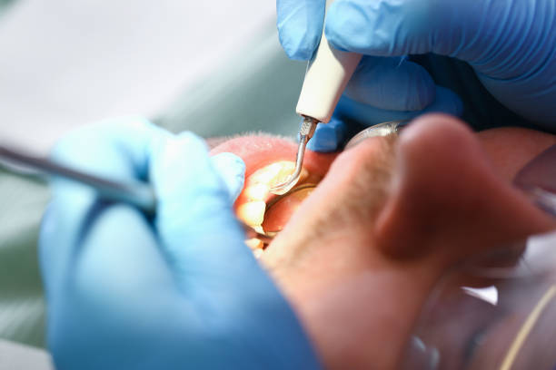 Best Emergency Wisdom Teeth Removal in Williams, CA